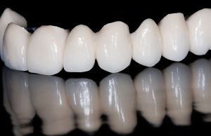 columbia dental bridges